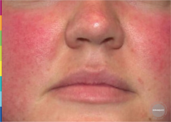 Dermaquest »5 Прэвил К.К. 