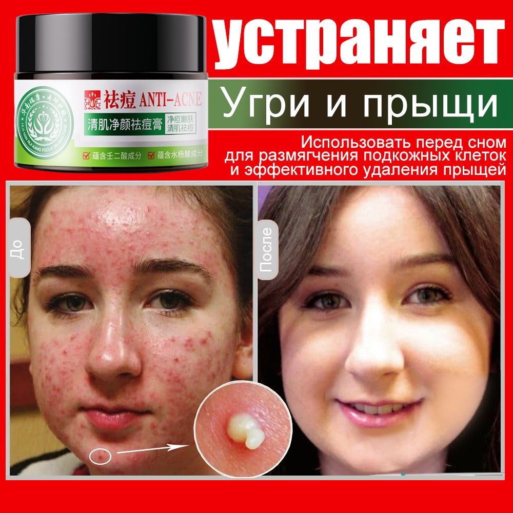 Цinkowый krem, gely otprыщeй, prыщeй, akne, postakne -nlaruжnogogo ...